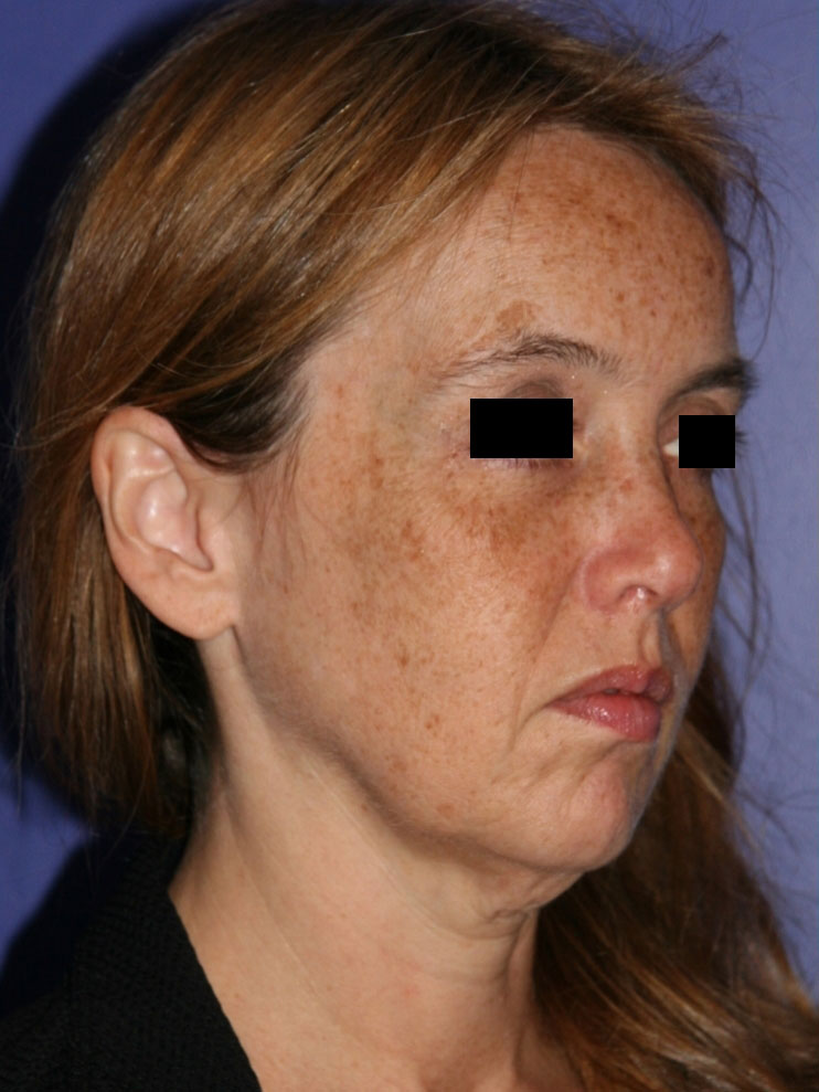 Facelift Before and After Photos San Francisco 342020