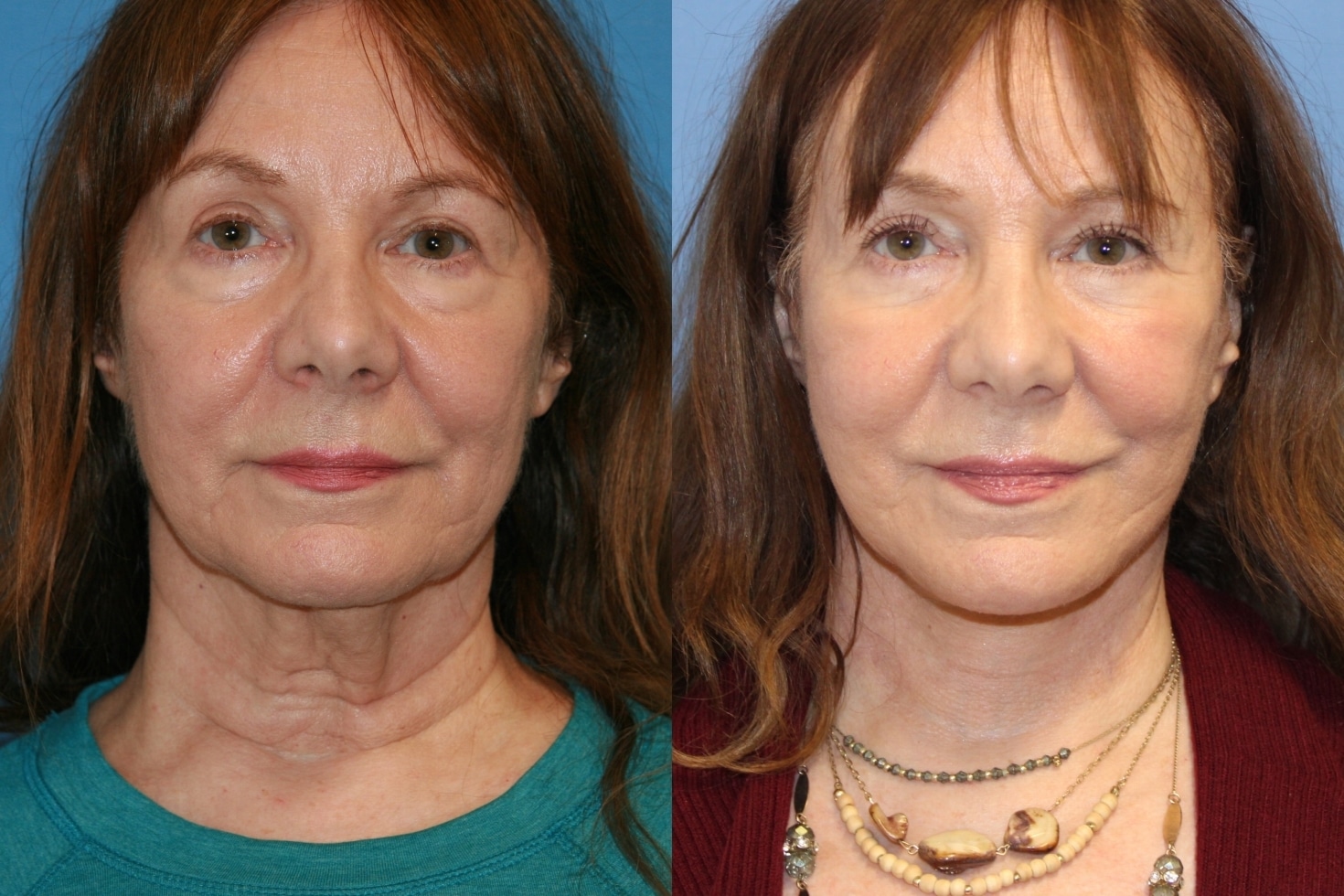 Facelift/Chin Implants/Neck Lift Before and After Photos San Francisco CA